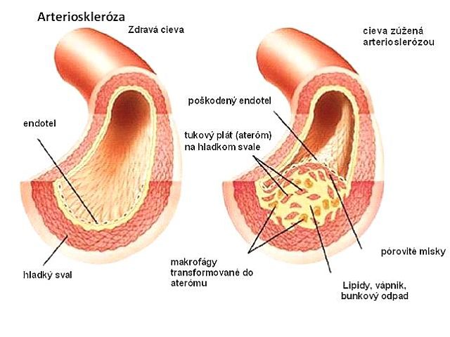 Arterioskleróza