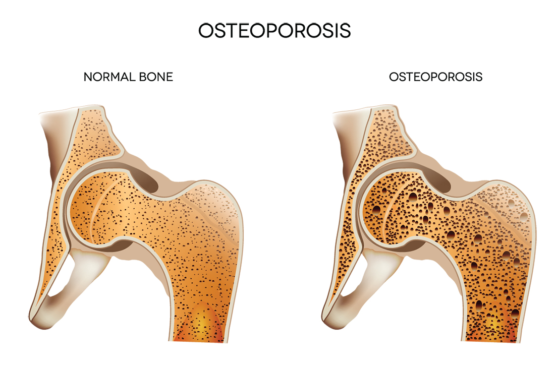 osteoporóza