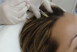 Vlasová mezoterapia vám dokáže vrátiť bujnú hrivu
