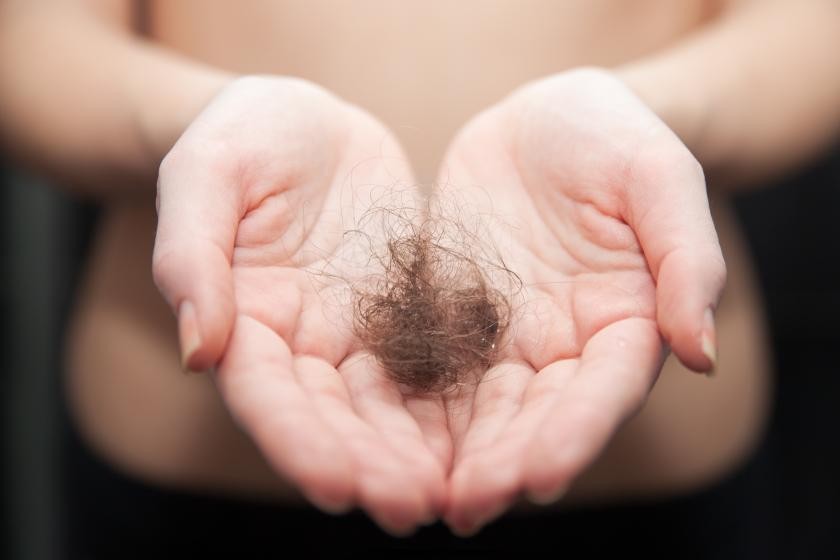 Typy plešatenia: Alopecia areata alebo keď váš vlastný imunitný systém napadá vlasy
