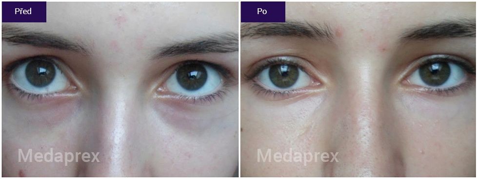 Redukcia kruhov pod očami – Medik8 Dark Circles